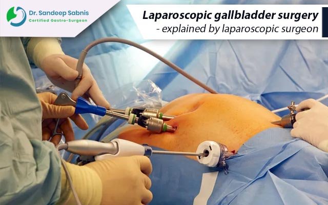 Laparoscopic gallbladder surgery